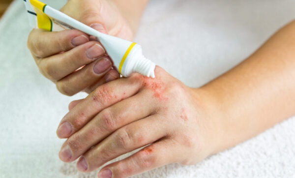 Complicaciones del tratamiento dermatológico tópico