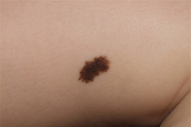 ¿Qué son los nevos melanocíticos?
