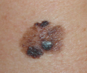 ¿Qué son los nevos atípicos?