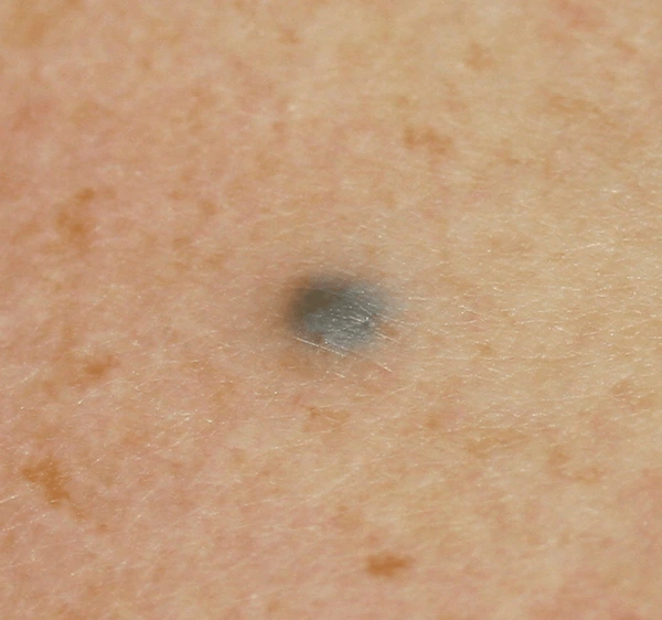 ¿Qué son los nevos azules?