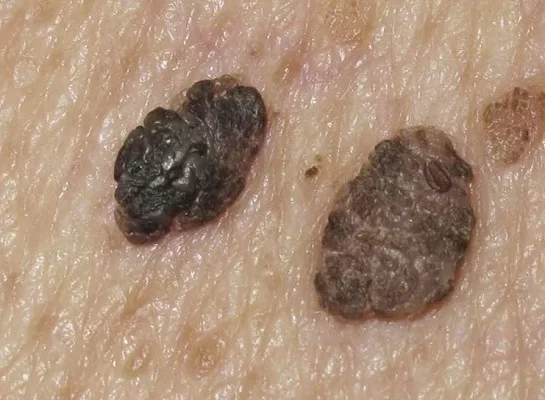 ¿Qué es la queratosis seborreica?