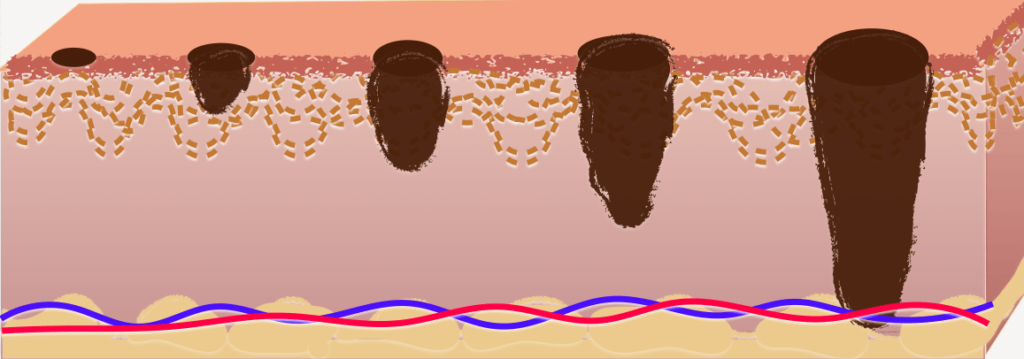 Supervivencia relacionada al grosor del melanoma