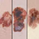 Clasificación clínica e histopatológica de los melanomas