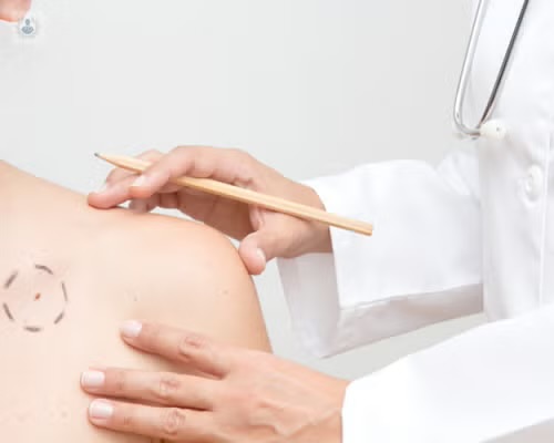 Tratamiento del melanoma maligno