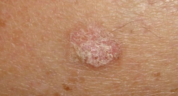 ¿Qué es la queratosis actínica?