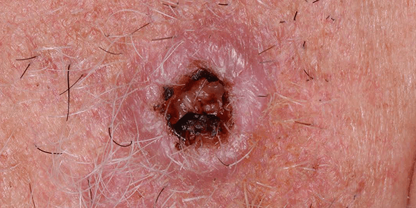 ¿Por qué aparece el carcinoma de células escamosas?