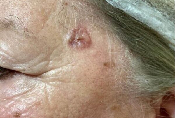 ¿Cuál es el tipo más común de cáncer de piel?