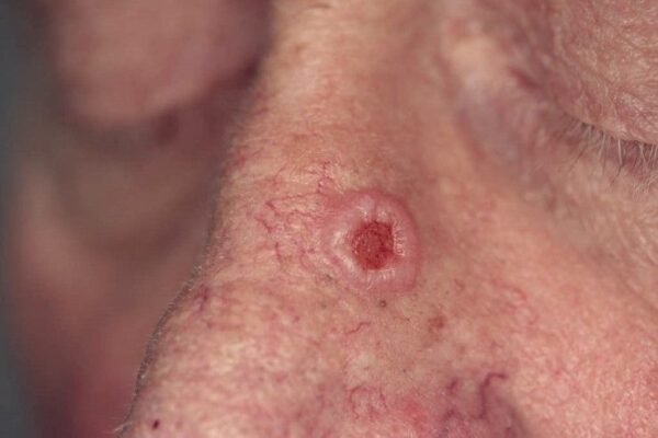 Características de los carcinomas basocelulares