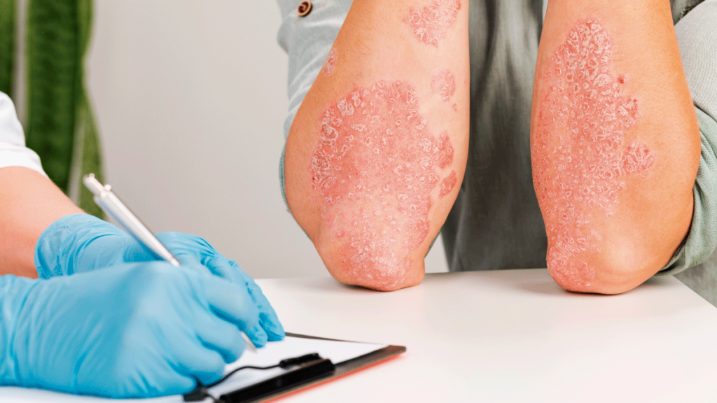 Generalidades de las infecciones fúngicas