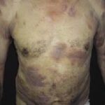 La micosis fungoides es un linfoma cutáneo de células T