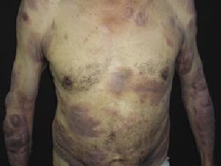 La micosis fungoides es un linfoma cutáneo de células T