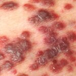 El virus herpes simple 8 causa sarcoma de Kaposi