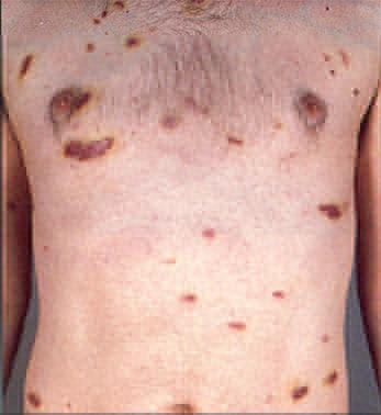 Tratamiento del sarcoma de Kaposi