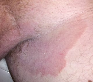 Tinea cruris o tiña inguinal
