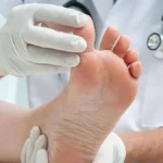 Diagnóstico diferencial de la tiña de manos y pies