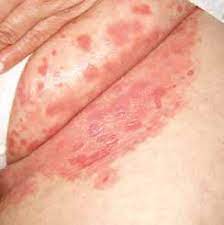 Tratamiento de la candidiasis mucocutánea