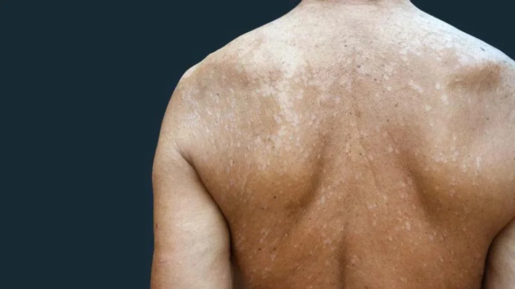 Pitiriasis versicolor es causada por Malassezia