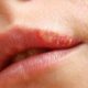 Infección por virus herpes simple