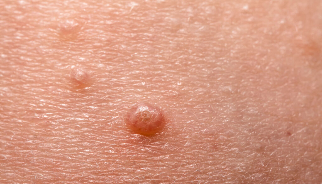 El molusco contagioso es una infección viral de la piel