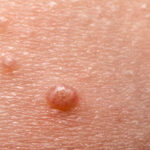 El molusco contagioso es una infección viral de la piel