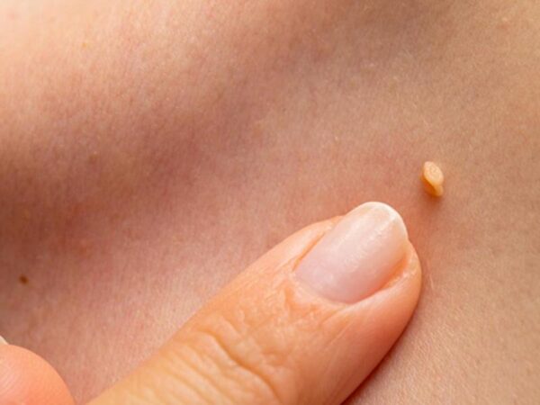 Las verrugas son causadas por el virus del papiloma humano