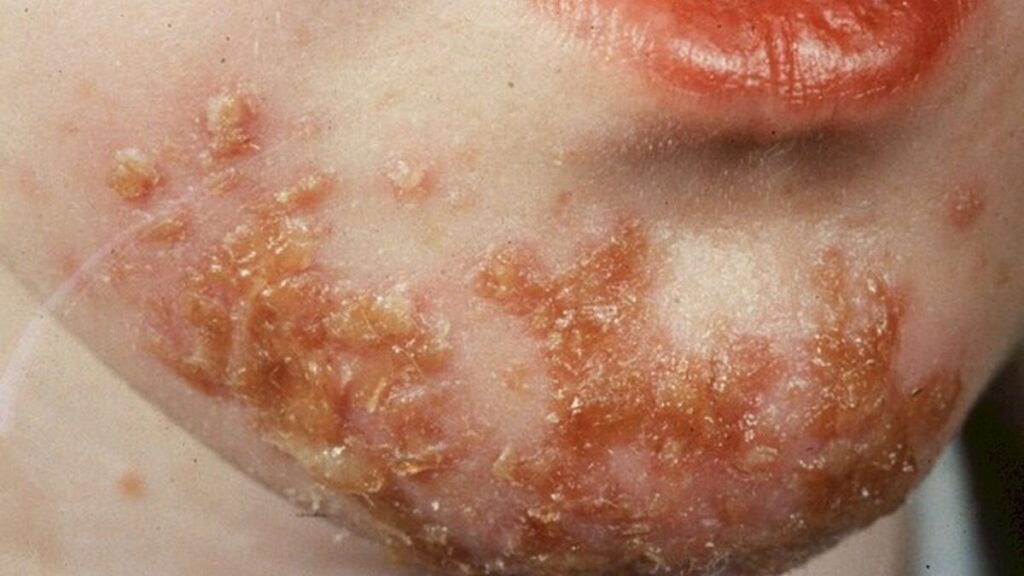 Manifestaciones clínicas del impétigo