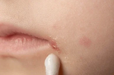 ¿Cuál es el tratamiento del impétigo?