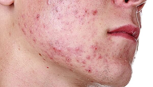 ¿Qué es la sicosis?