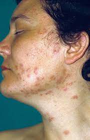 ¿Qué es la foliculitis eosinofílica?