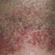 ¿Qué es la pseudofoliculitis por pelos encarnados?