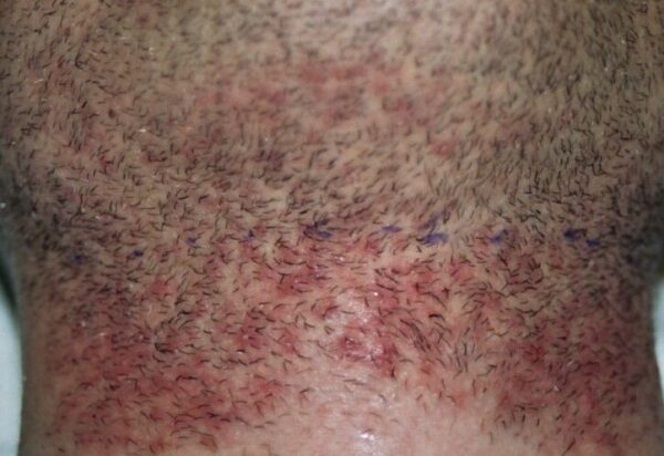 ¿Qué es la pseudofoliculitis por pelos encarnados?
