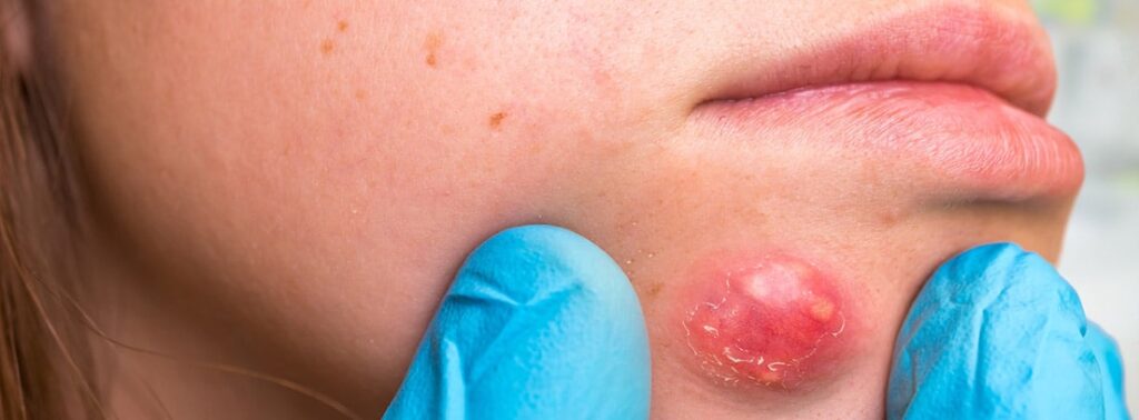 ¿Cuál es la principal complicación de la foliculitis?