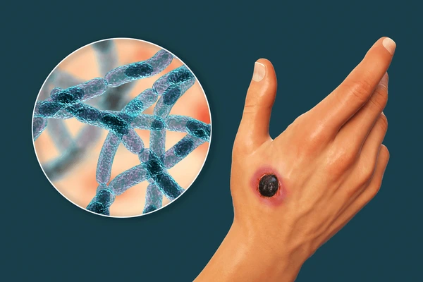 ¿Qué es el ántrax o carbunco?