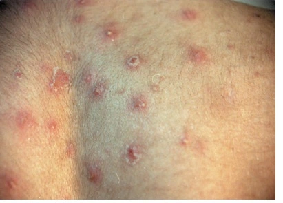 ¿Qué es la furunculosis recurrente?