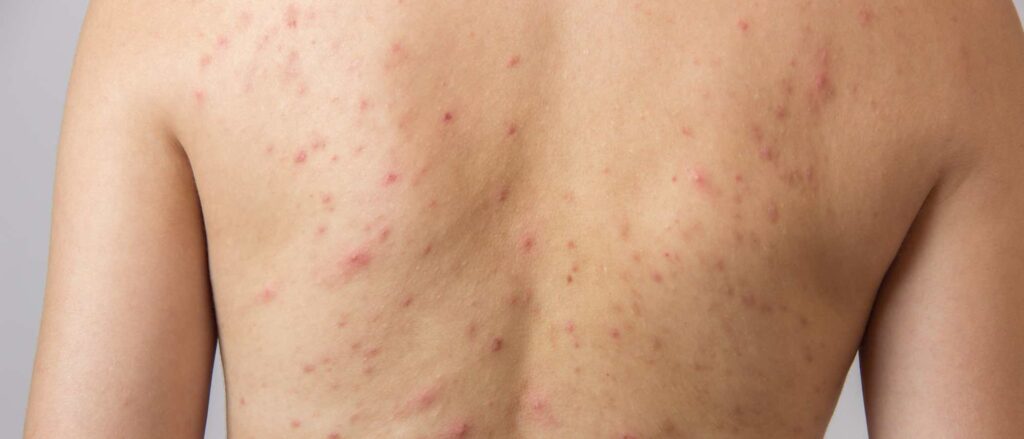 Características clínicas de la furunculosis