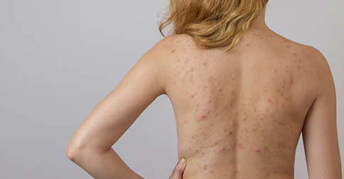 Diagnóstico diferencial de la furunculosis