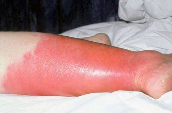 La celulitis es una infección común