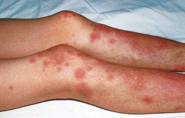 ¿Cuál es la causa del eritema nodoso?