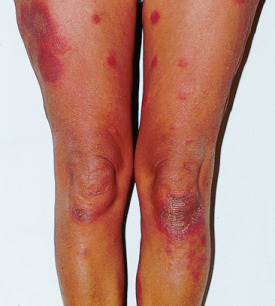 Manifestaciones clínicas del eritema nodoso