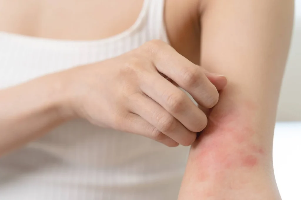 La Dermatitis Atópica es una inflamación crónica