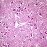 Morfología de la lesión neuronal aguda