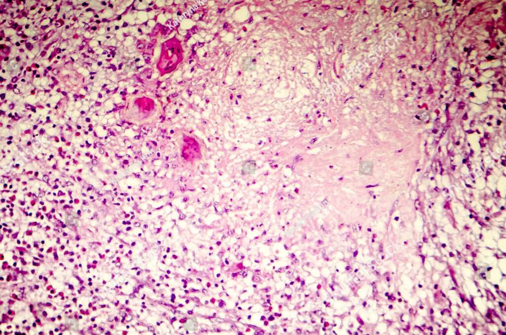 Morfología de la lesión neuronal subaguda y crónica