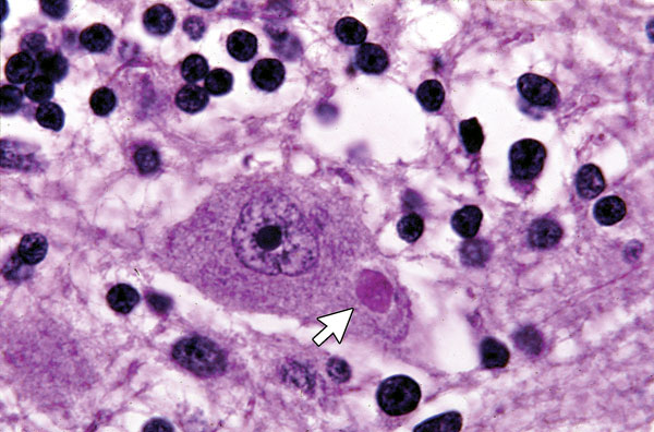 ¿Qué son las inclusiones neuronales?