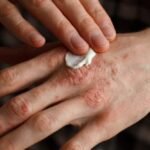 Tratamiento tópico de la dermatitis atópica