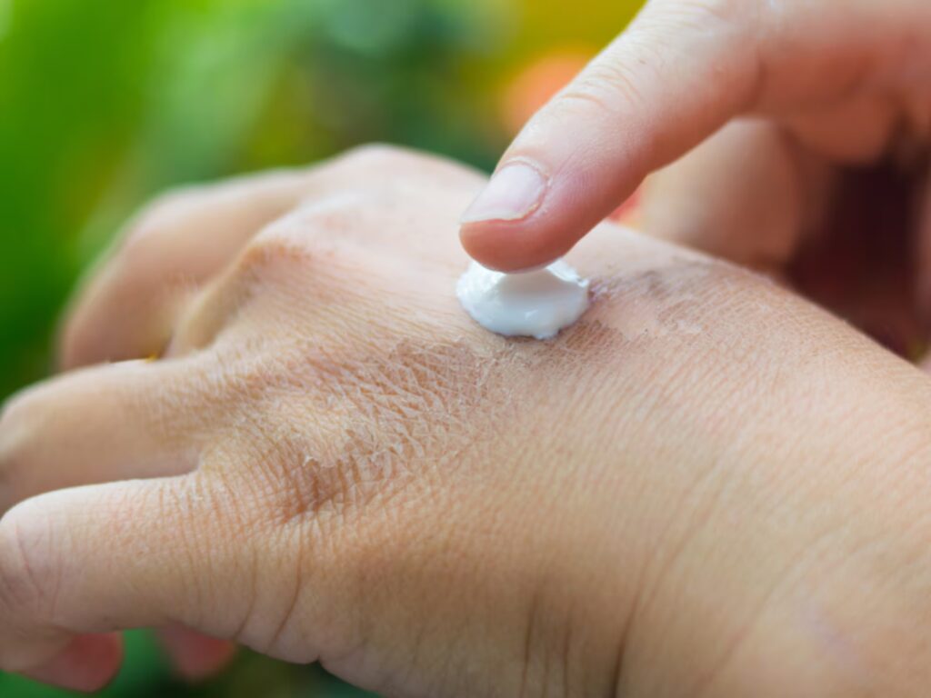 Manejo de las lesiones agudas supurantes