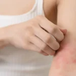 Tratamiento sistémico de la dermatitis atópica