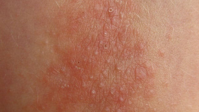 Liquen simple crónico