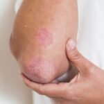 La psoriasis es una enfermedad inflamatoria crónica