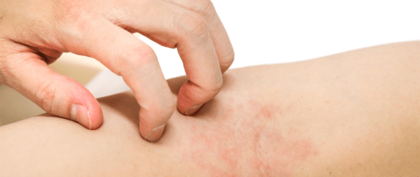 Tratamiento para la dermatitis atópica limitada