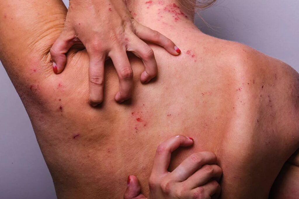 Tratamiento de la dermatitis atópica moderada a severa
